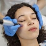 The Ultimate Guide to Microneedling in Vancouver