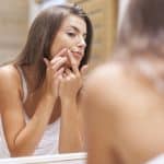 Best Treatments for Acne Scars